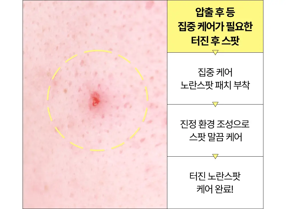 [짜기전/후][온라인단독] 해서린 스팟케어 빅패치 68매 상세페이지 33
